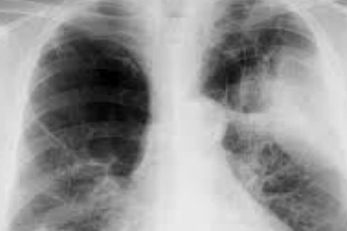 Así se ven los pulmones de un paciente con la EPOC