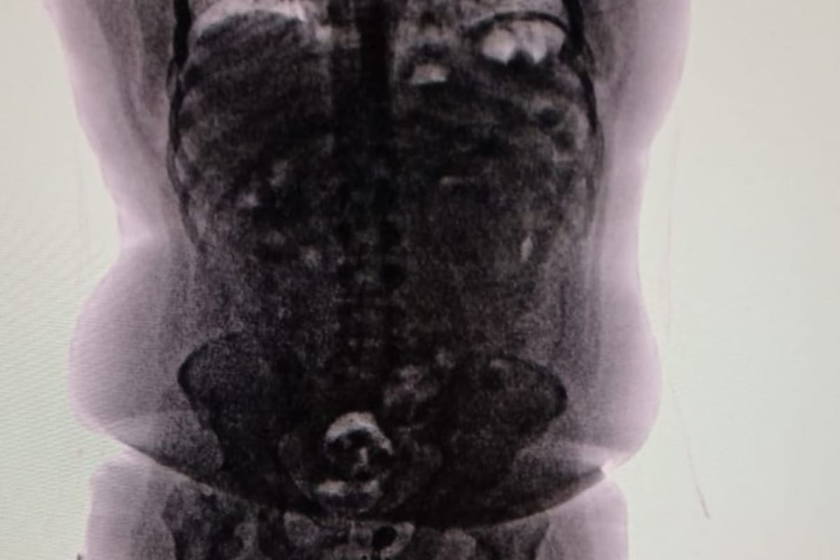 Así veía el cuerpo de la "mula" en el escáner