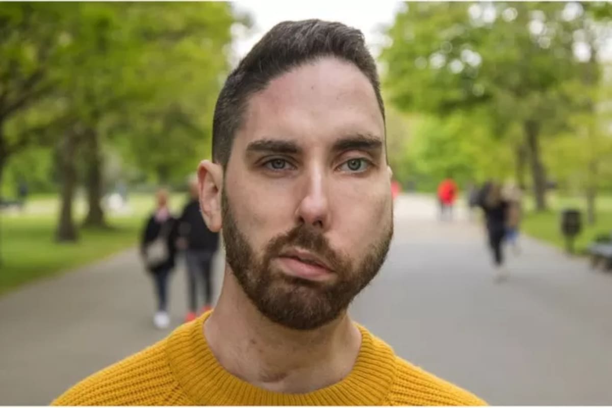 Atholl Mills forma parte de una campaña de sensibilización en Reino Unido sobre el impacto que tienen las miradas de las personas sobre gente que vive con desfiguraciones físicas