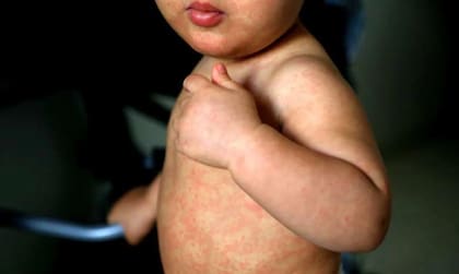 Aumenta la preocupación en Vermont y Nuevo Hampshire por el aumento de casos de sarampión (Imagen de Paho.org)