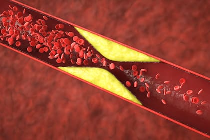 Aún personas jóvenes y con pocos factores de riesgo pueden tener arterias con placa acumulada en sus paredes debido a una predisposición genética