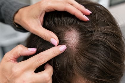Aunque es mejor identificarlo temprano, este tipo de cáncer de piel suele ser de crecimiento lento