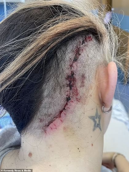 Aunque la operación para extirparle el tumor fue un éxito, Clark sufrió parálisis facial