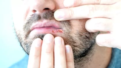 Aunque no hay una cura definitiva, se están investigando terapias genéticas y vacunas para combatir el virus del herpes