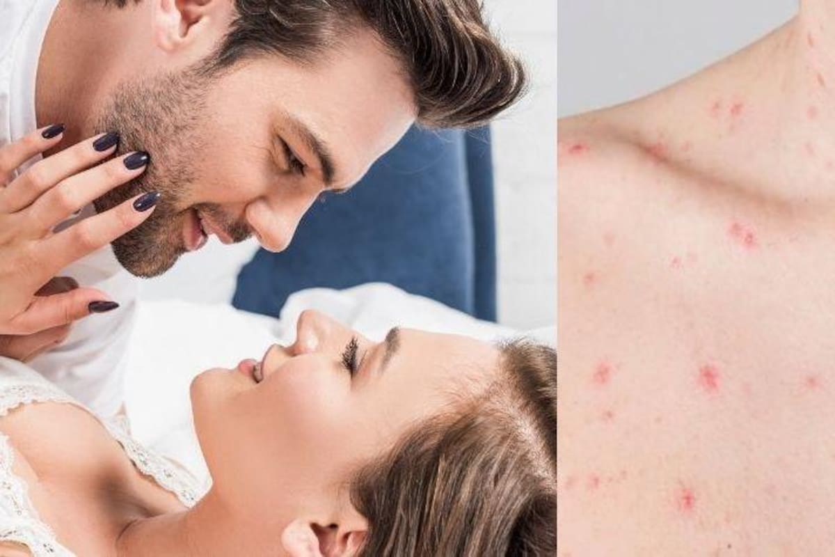 Autoridades británicas piden a los ciudadanos no tener sexo para evitar contraer viruela del mono