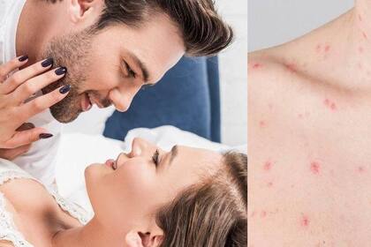 Autoridades británicas piden a los ciudadanos no tener sexo para evitar contraer viruela del mono