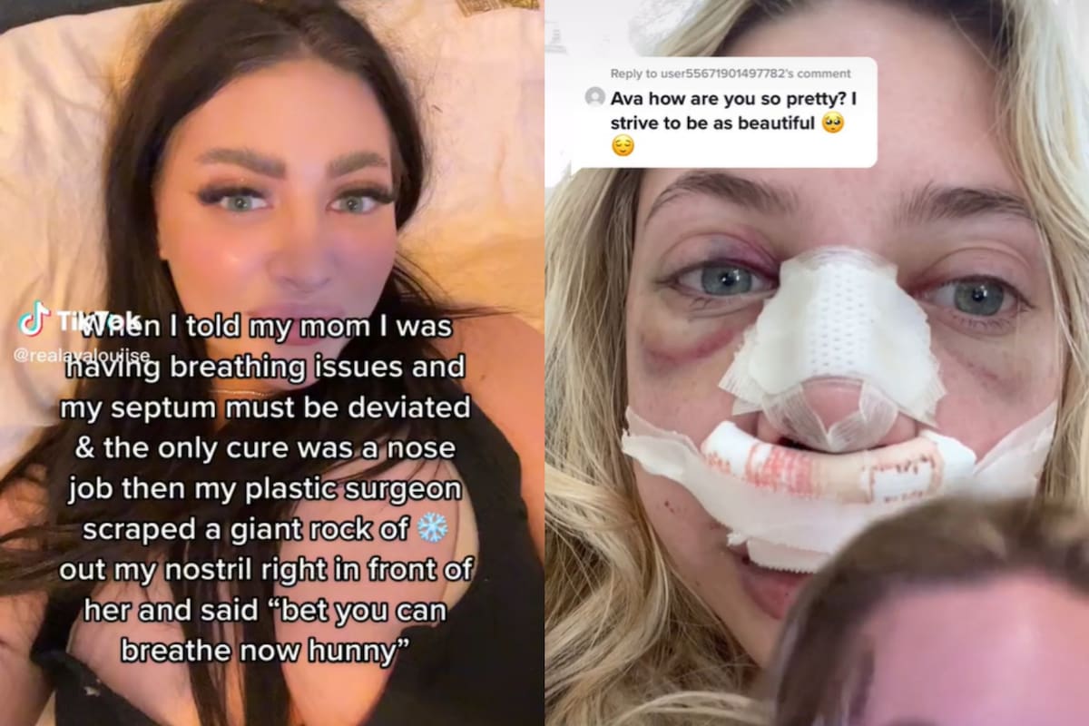 Ava Louis decía que tenía desviado el tabique, pero la realidad era otra