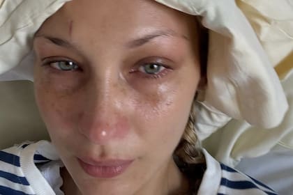 Bella Hadid suele mostrar en sus redes sociales sus recaídas tras ser diagnosticada con la enfermedad de Lyme en 2012