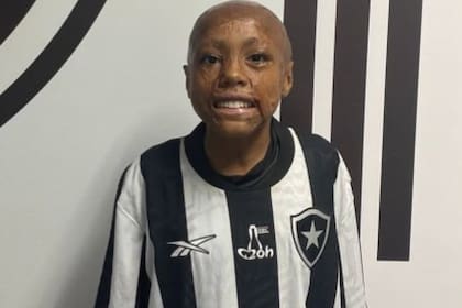 Bernardo Lopes y una historia de vida marcada por una quemadura en su rostro