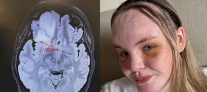 Bethany Wright y el peor diagnóstico: tenía un tumor maligno en el cerebro