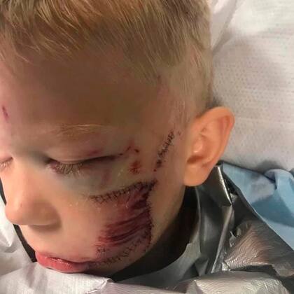 Bridger recibió casi 100 puntos en su cachete izquierdo pero ya se está recuperando favorablemente. Fuente: Instagram.