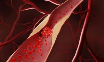 Cada año se realizan entre 65.000 y 75.000 angioplastias coronarias en el país