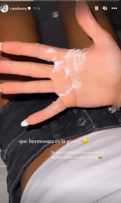 Camila Homs relató el accidente casero que sufrió en Punta del Este.