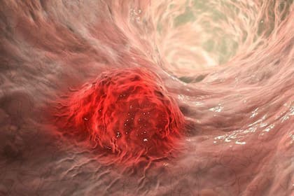 Cáncer; Cáncer colorrectal; sociedad; BBC; BBC Mundo; Salud; ciencia; Tumor; intestino; OMS; alimentos procesados; obesidad; sedentarismo; alimentos ultraprocesados; colonoscopia