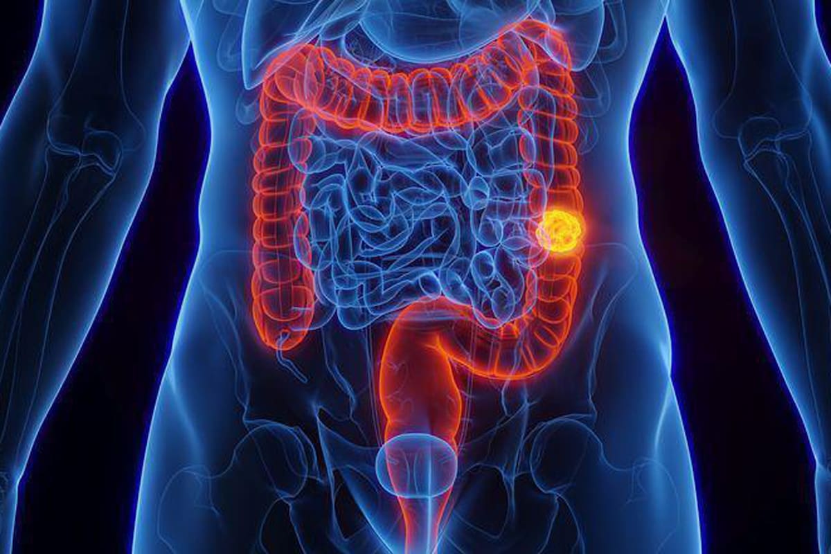 Cáncer; Cáncer colorrectal; sociedad; BBC; BBC Mundo; Salud; ciencia; Tumor; intestino; OMS; alimentos procesados; obesidad; sedentarismo; alimentos ultraprocesados; colonoscopia
