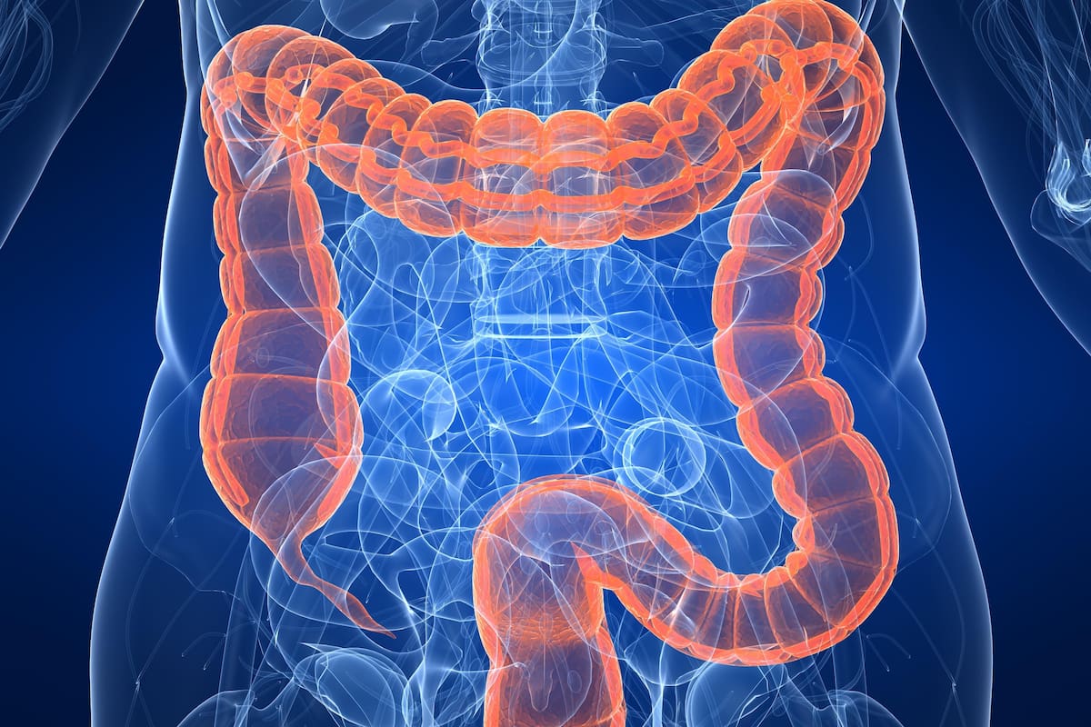 Cáncer de colon