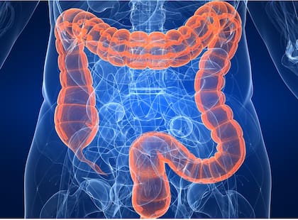Cáncer de colon
