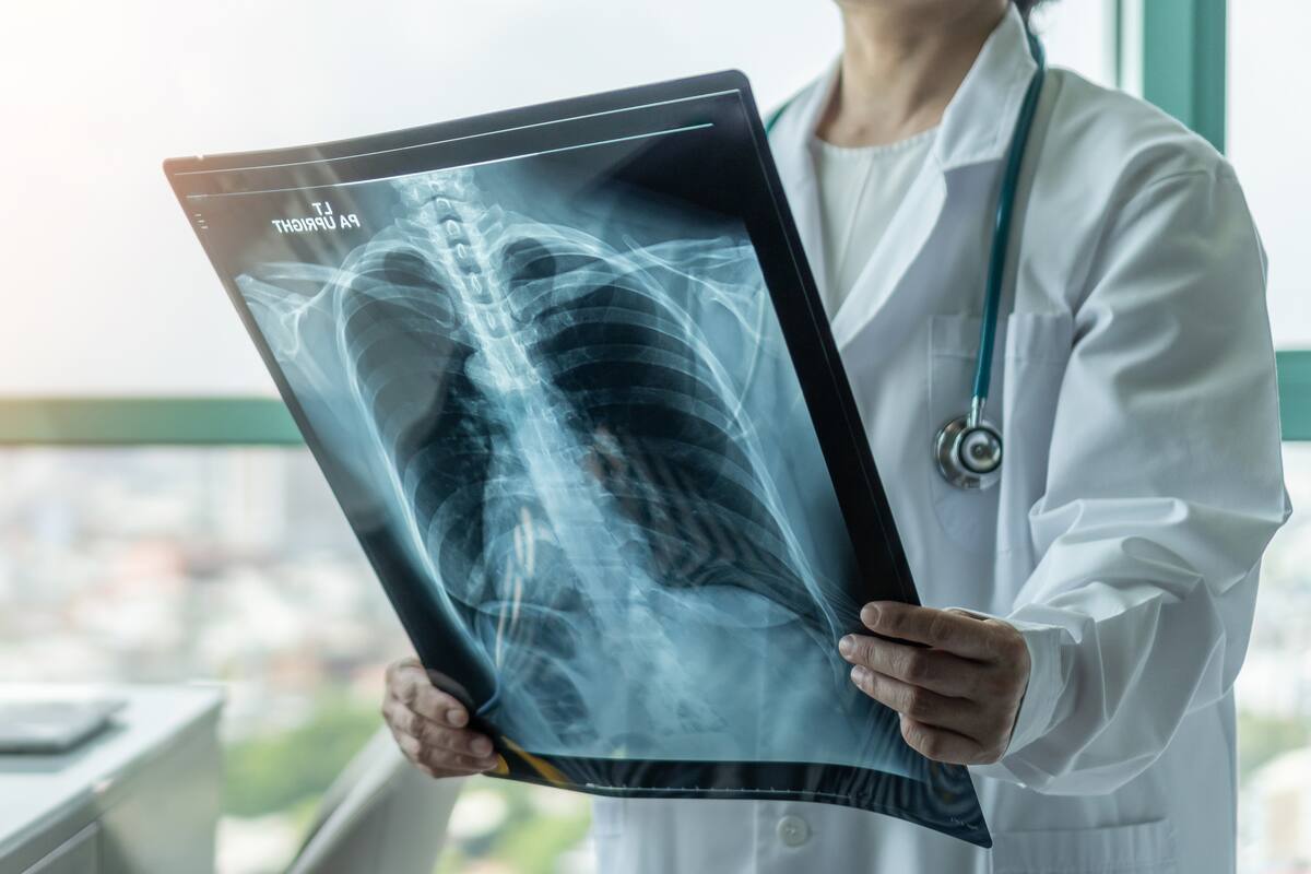 Cáncer de pulmón: para los médicos hay un “vacío crítico” para la detección temprana de la enfermedad