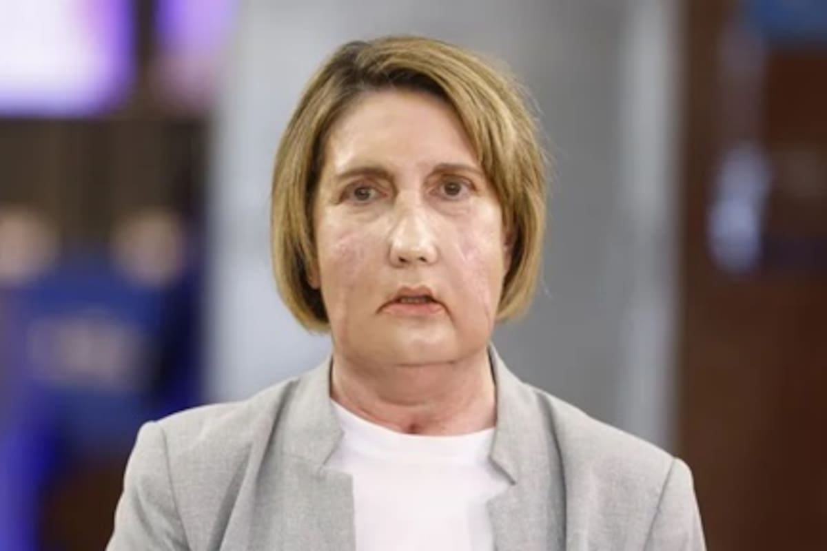 Carme es la receptora del primer trasplante de cara del mundo a partir de una donante que recibió la eutanasia.