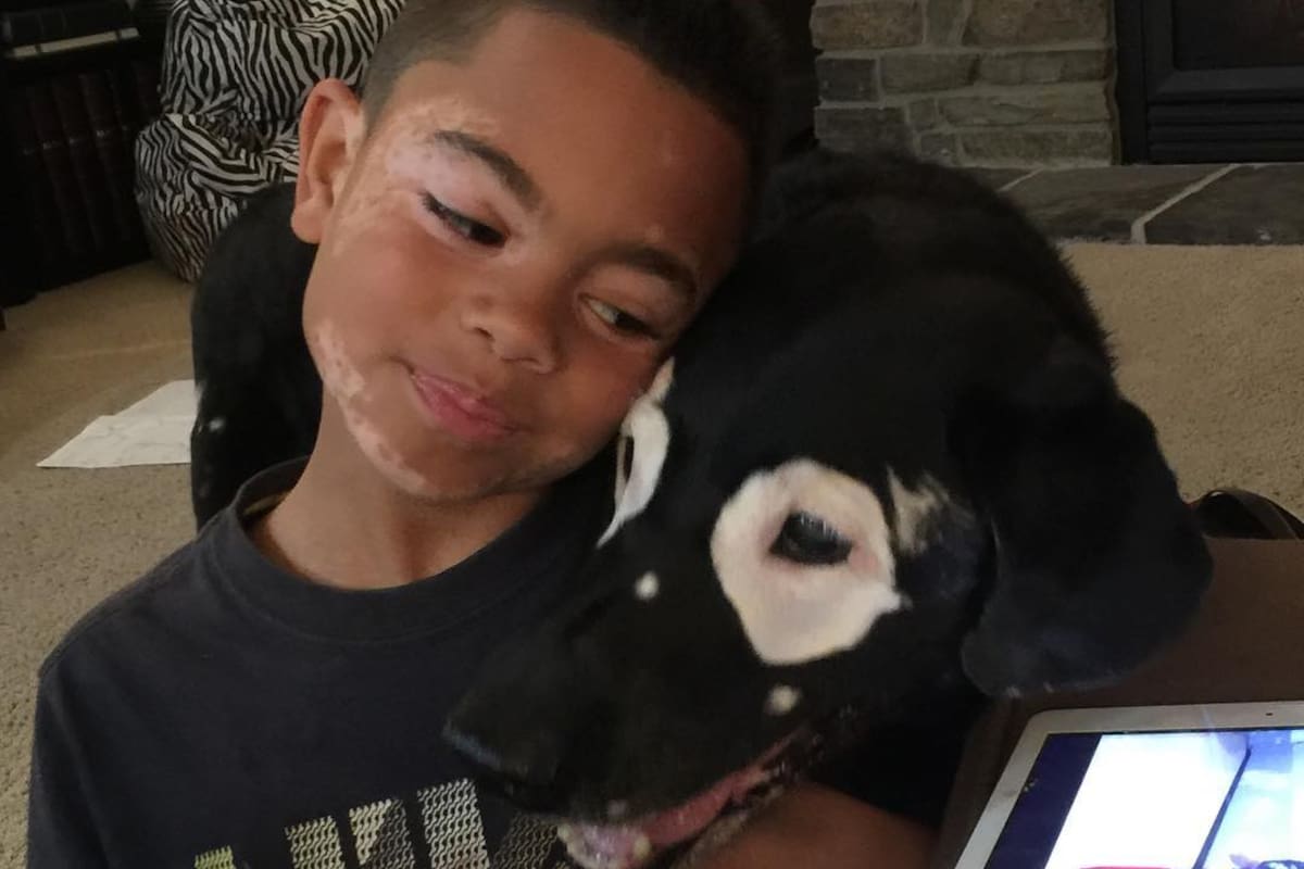 Carter y Rowdy tenían Vitiligo, una enfermedad de la piel