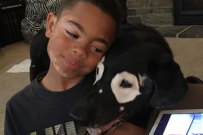 Carter y Rowdy tenían Vitiligo, una enfermedad de la piel