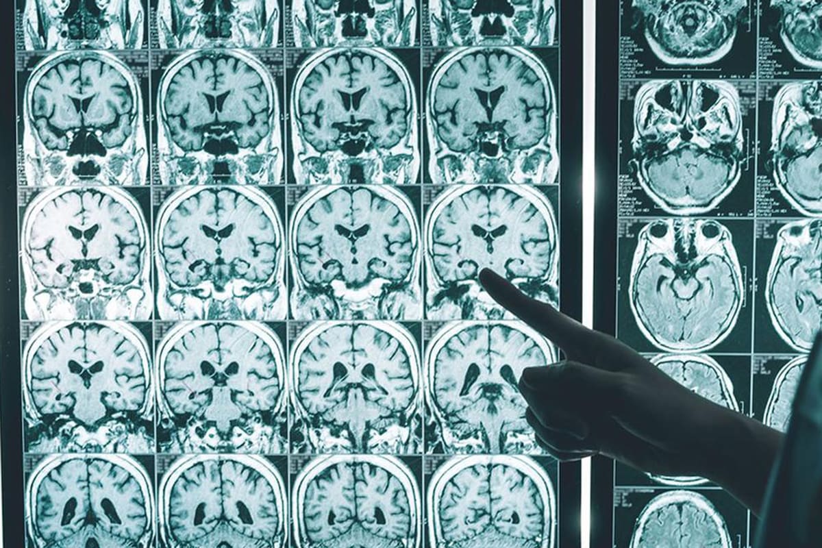 Casi todos los casos de enfermedad de Alzheimer en personas menores de 30 años se deben a genes defectuosos heredados