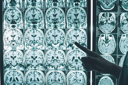 Casi todos los casos de enfermedad de Alzheimer en personas menores de 30 años se deben a genes defectuosos heredados