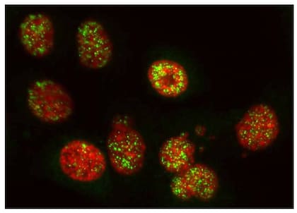 Células de cáncer de páncreas en las que se observa el ADN (en rojo) y el sensor del sistema inmune cGAS (en verde), cuya activación favorece la respuesta inmunológica contra el tumor