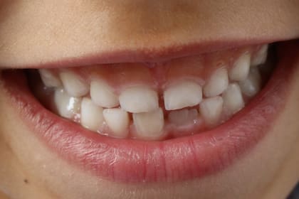 Cepillarse los dientes correctamente y usar hilo dental son pasos fundamentales para eliminar la placa bacteriana