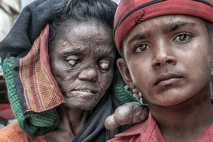 Cerca del 80% de todos los casos nuevos ocurren en India, Brasil e Indonesia.