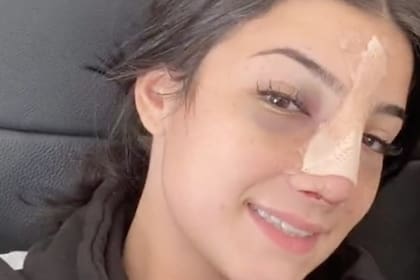 Charli DAmelio, la adolescente más popular de TikTok, después de su cirugía de nariz