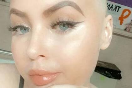 Chloe-Leigh Todd después de perder su cabello por tratamiento contra el cáncer. (Imagen: Chloe Todd / SWNS).