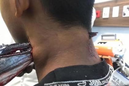 Cinco médicos retiraron lo que quedaba del pez espada en una cirugía de una hora de duración