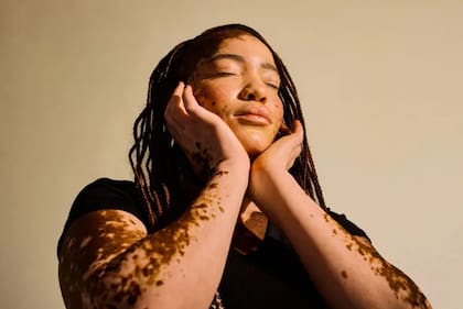 Se cree que la melanina, el pigmento que le da color a las pieles más oscuras, es el factor clave en el desarrollo del moho de Chernóbil.