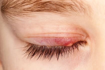 Cómo curar un orzuelo: consejos prácticos para la casa