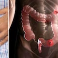 Cáncer de colon: cuáles son sus síntomas, factores de riesgo y cómo prevenirlo