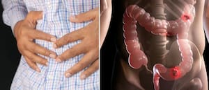 Cáncer de colon: cuáles son sus síntomas, factores de riesgo y cómo prevenirlo