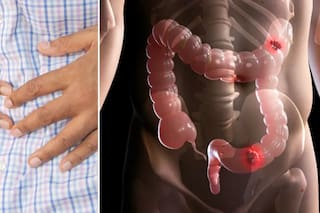 Cáncer de colon: cuáles son sus síntomas, factores de riesgo y cómo prevenirlo