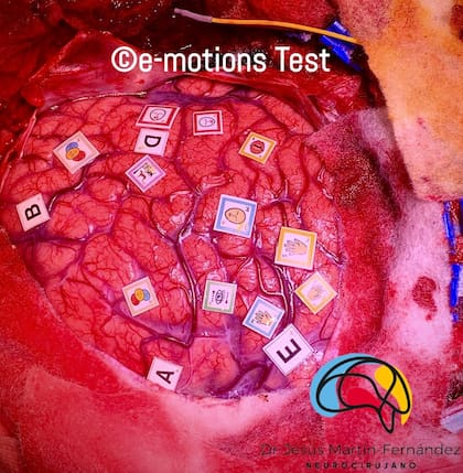 Cómo se mapean en el cerebro las diferentes zonas cognitivas y emocionales