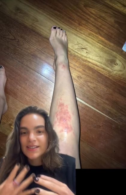 Con el paso de los días, la pierna de la joven se tornó más roja. El parásito se expandía de noche