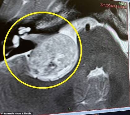 Con una resonancia magnética descubrieron la causa real de sus síntomas, un tumor cerebral poco común