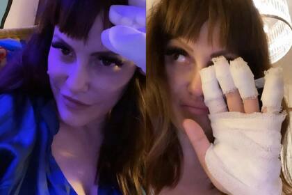 Connie Ansaldi se quemó cinco dedos y exhibió la mano vendada en las redes sociales