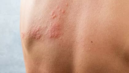 Conseguir que más personas se protejan frente al herpes zóster ya supone, por ahora, un reto enorme para comunidades y sociedades científicas