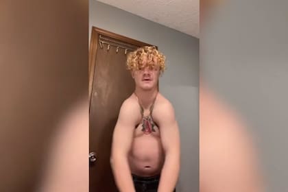 Corey Bennet, un joven de 19 años, de Indiana, Estados Unidos, nació sin clavícula debido a una rara enfermedad llamada disostosis cleidocraneal