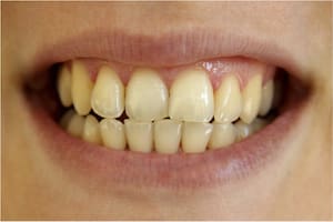 Cuál es el tip para que los dientes no queden amarillentos
