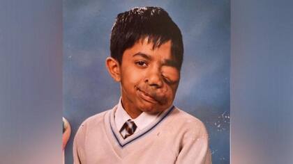 Cuando tenía 11 años, Ghose fue operado para extirparle el ojo izquierdo