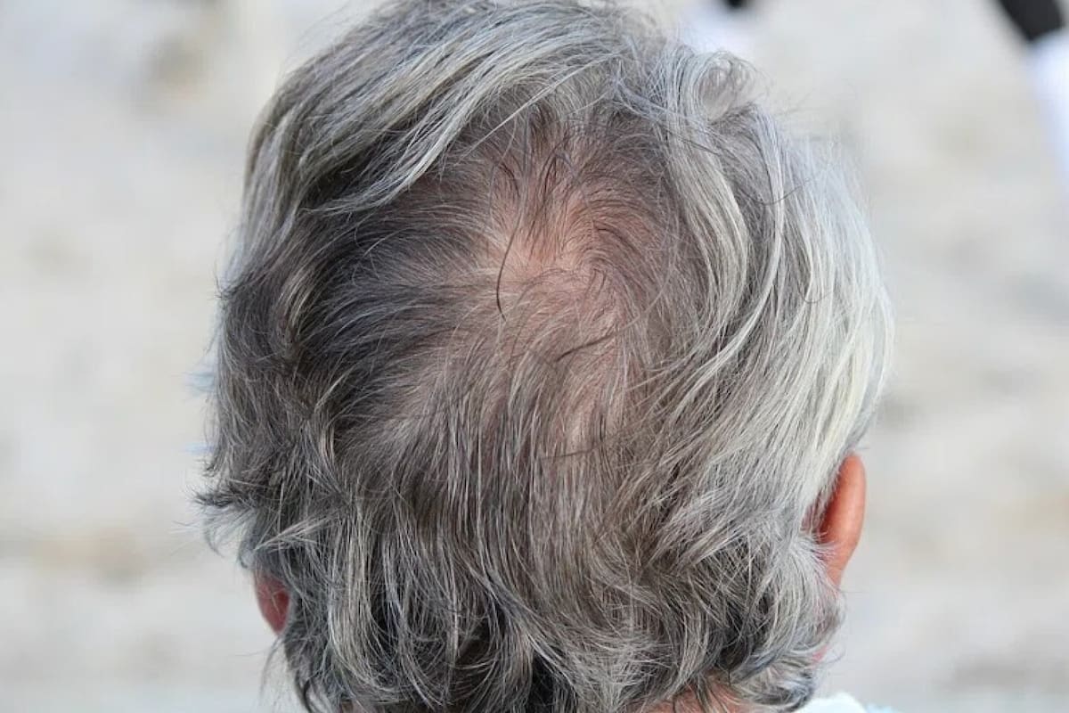 Cuanto menos cortisol, y cuanta más vida sana, más tarde aparecen las canas.Foto: Rawpixel.