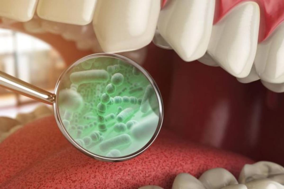 Cuatro enfermedades vinculadas a las bacterias de tu boca