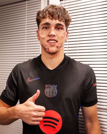 Cubarsí, en 2024, dando tranquilidad luego de sufrir un golpe en el rostro durante un partido de la Liga de Campeones contra Estrella Roja, que le demandó diez puntos de sutura
