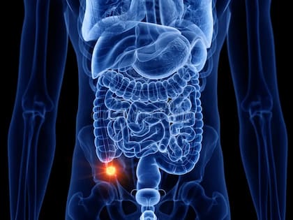 De acuerdo con el Instituto Nacional del Cáncer de Estados Unidos, el cáncer de apéndice es muy poco común